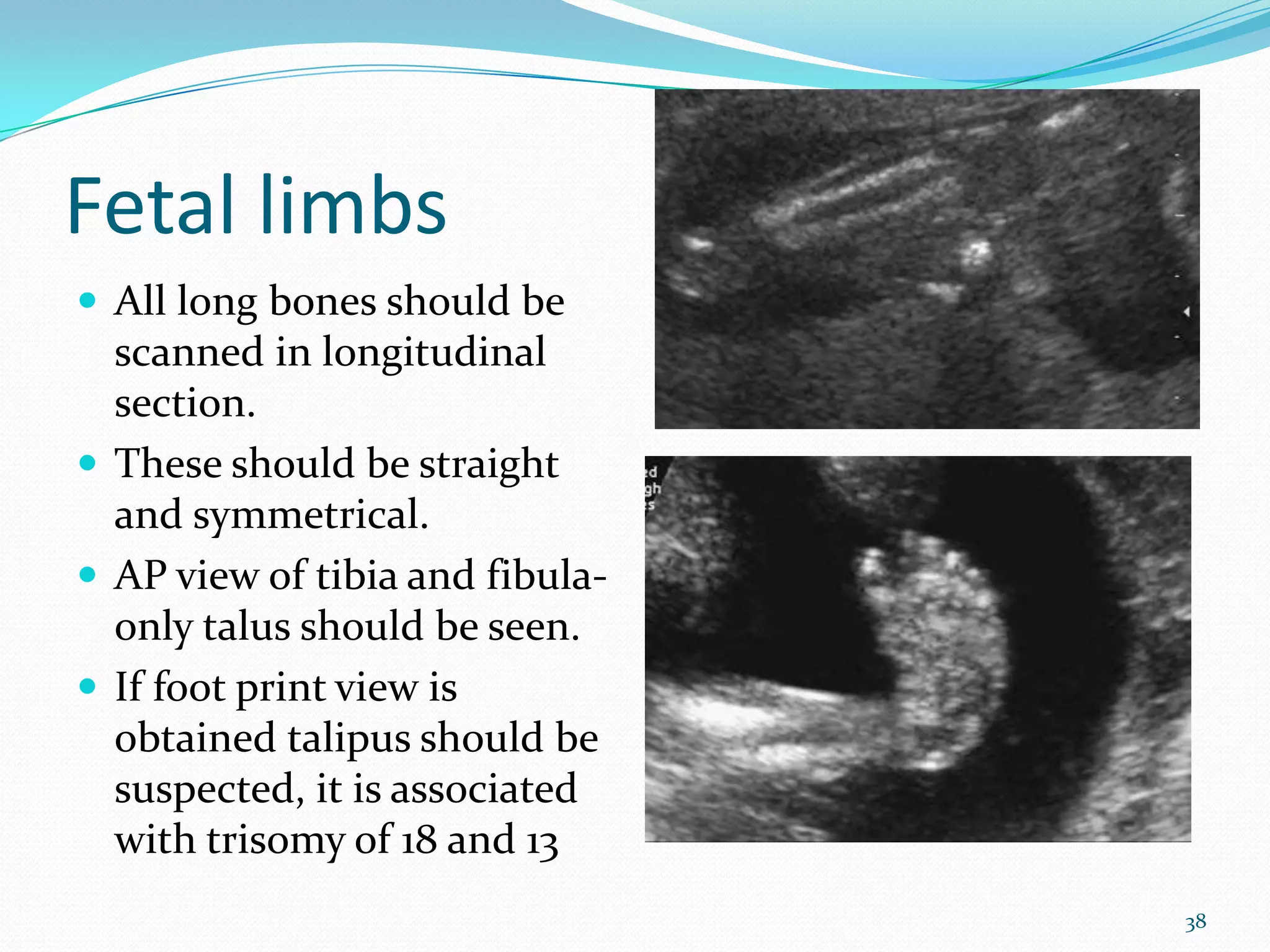 Fetal limbs
 All long bones should be
  scanned in longitudinal
  section.
 These should be straight
  and symmetrical.
 AP view of tibia and fibula-
  only talus should be seen.
 If foot print view is
  obtained talipus should be
  suspected, it is associated
  with trisomy of 18 and 13
                                 38
 