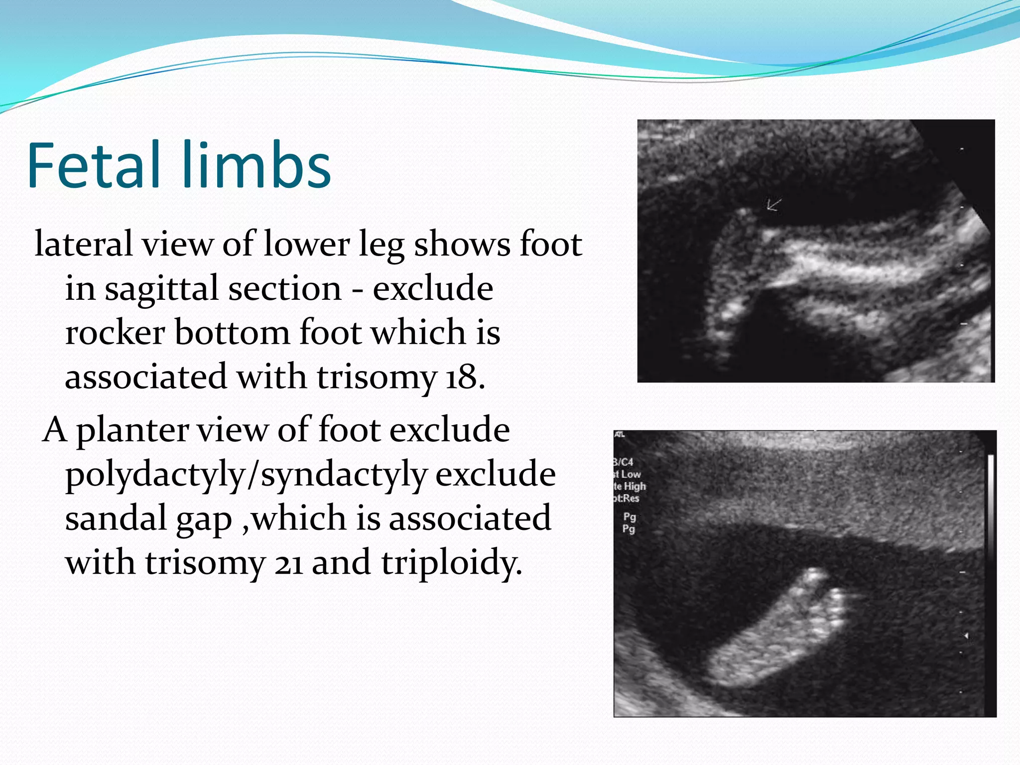 Fetal limbs
lateral view of lower leg shows foot
  in sagittal section - exclude
  rocker bottom foot which is
  associated with trisomy 18.
 A planter view of foot exclude
  polydactyly/syndactyly exclude
  sandal gap ,which is associated
  with trisomy 21 and triploidy.
 
