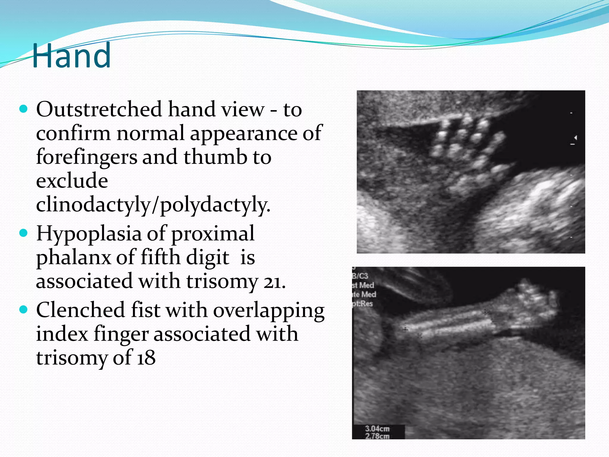 Hand
 Outstretched hand view - to
  confirm normal appearance of
  forefingers and thumb to
  exclude
  clinodactyly/polydactyly.
 Hypoplasia of proximal
  phalanx of fifth digit is
  associated with trisomy 21.
 Clenched fist with overlapping
  index finger associated with
  trisomy of 18
 