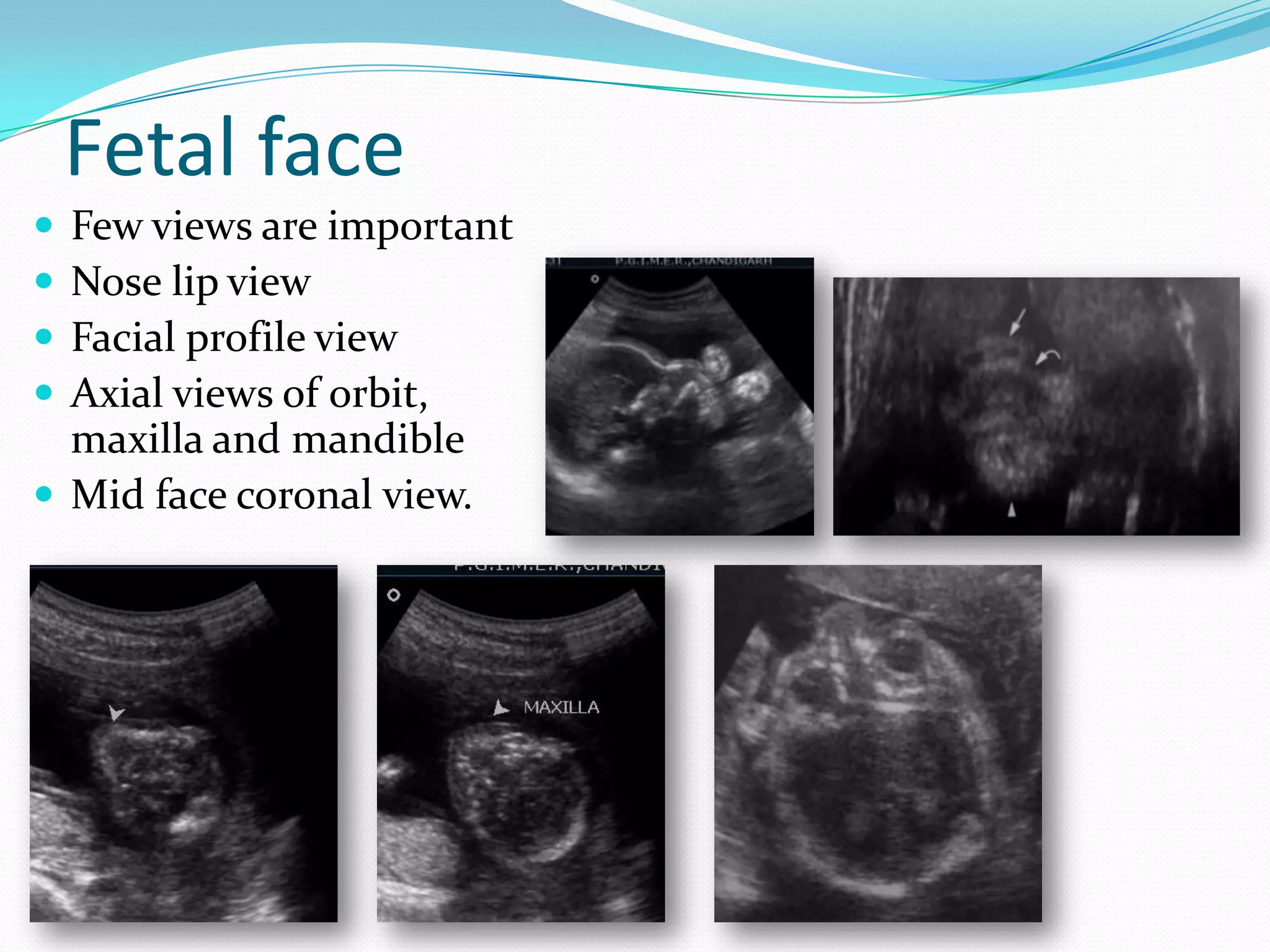 Fetal face
 Few views are important
 Nose lip view
 Facial profile view
 Axial views of orbit,
  maxilla and mandible
 Mid face coronal view.
 