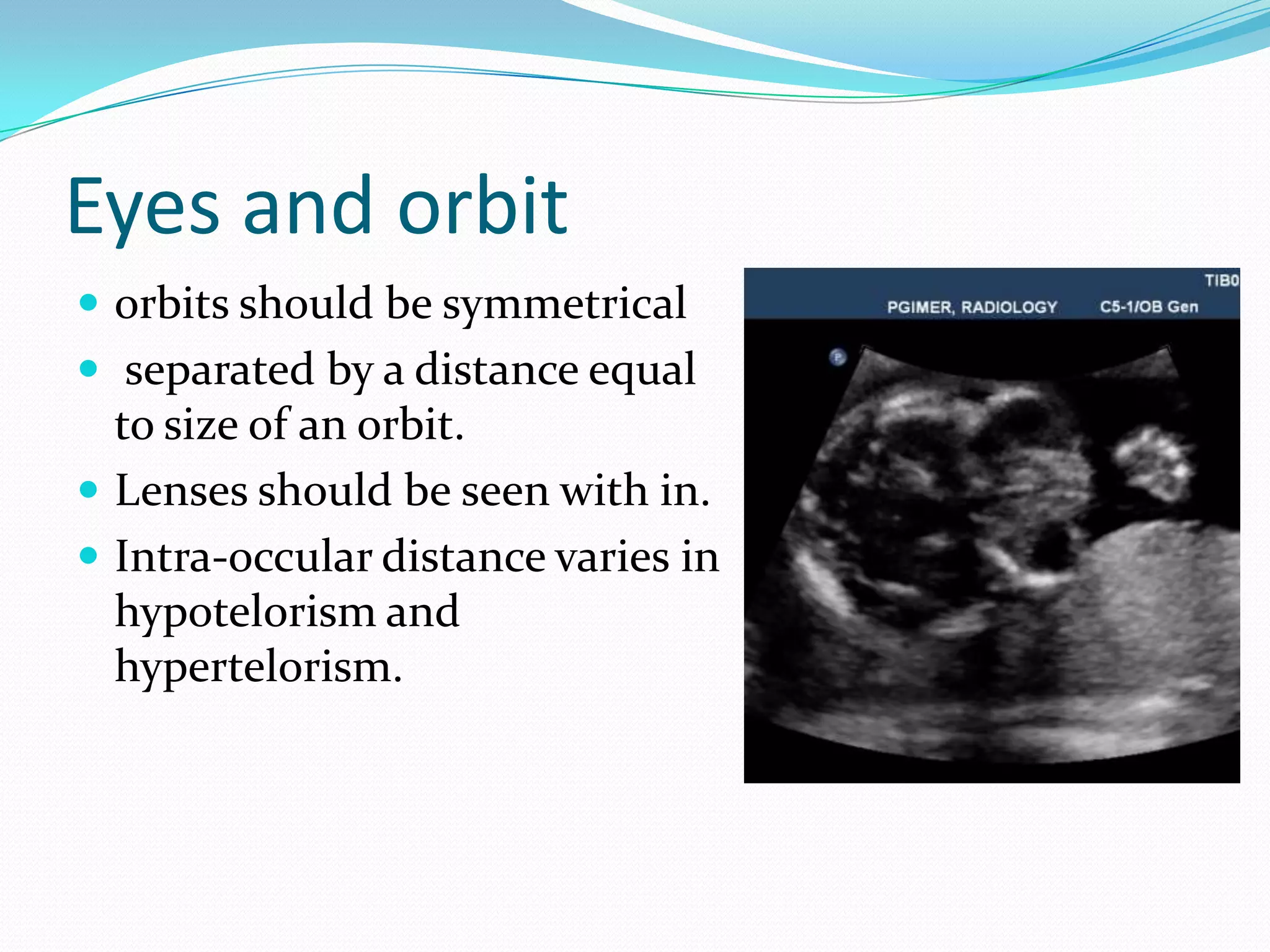 Eyes and orbit
 orbits should be symmetrical
 separated by a distance equal
  to size of an orbit.
 Lenses should be seen with in.
 Intra-occular distance varies in
  hypotelorism and
  hypertelorism.
 