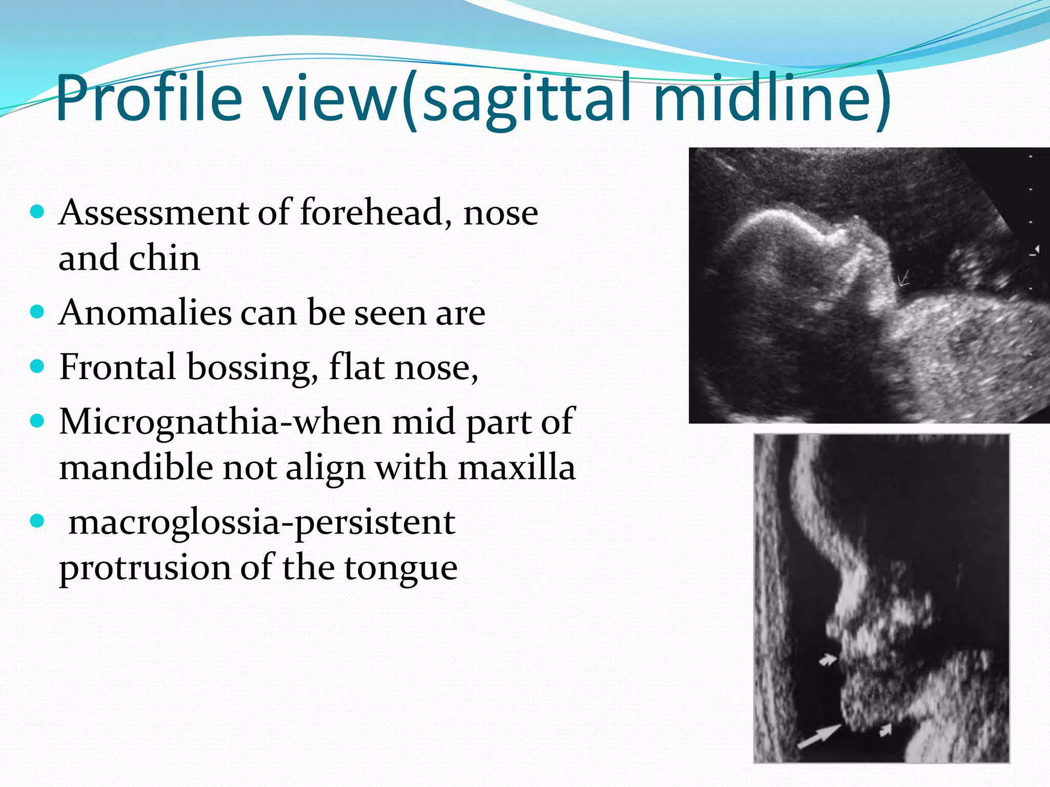 Profile view(sagittal midline)
 Assessment of forehead, nose
    and chin
   Anomalies can be seen are
   Frontal bossing, flat nose,
   Micrognathia-when mid part of
    mandible not align with maxilla
    macroglossia-persistent
    protrusion of the tongue
 