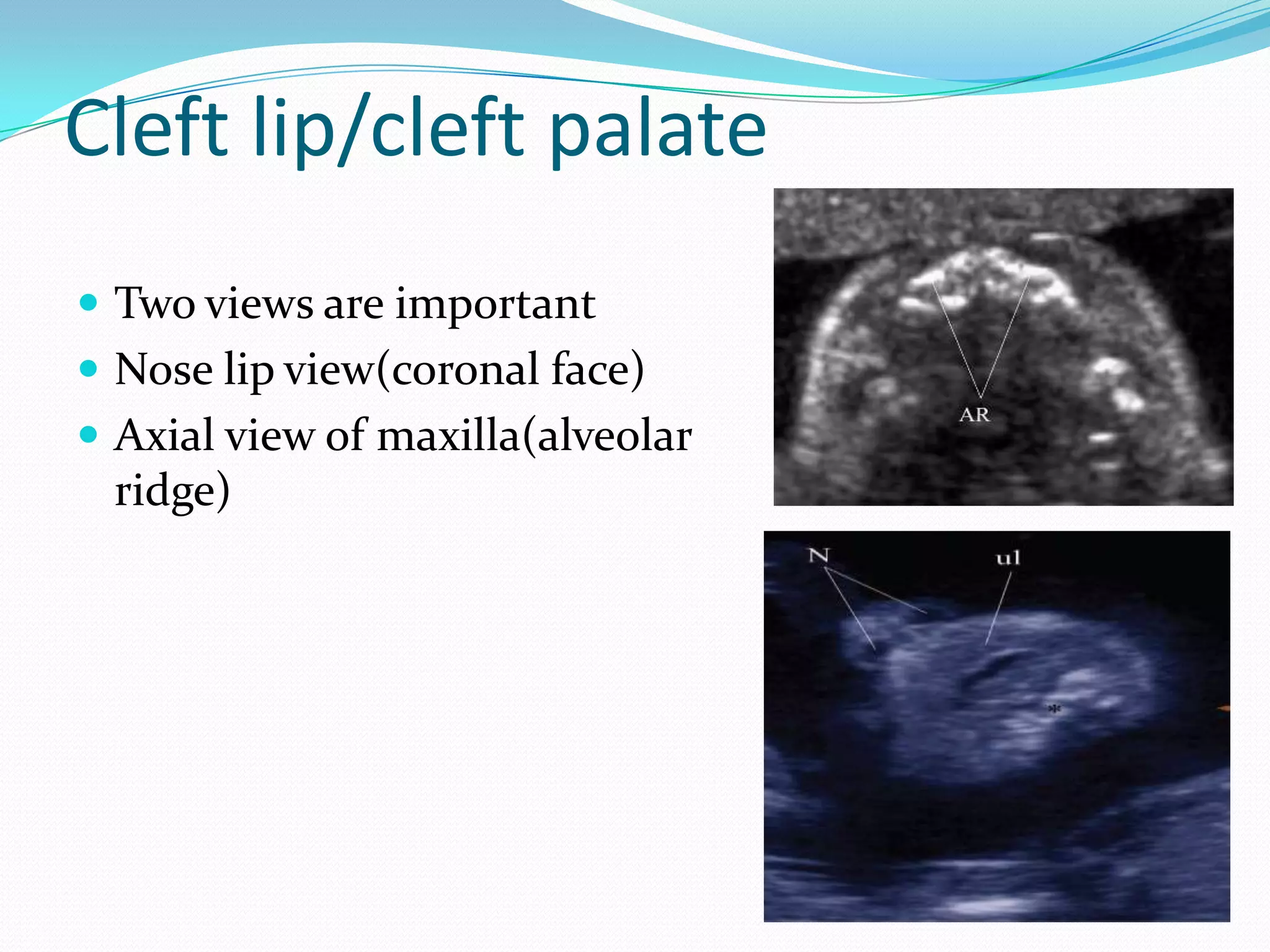 Cleft lip/cleft palate
 Two views are important
 Nose lip view(coronal face)
 Axial view of maxilla(alveolar
 ridge)
 