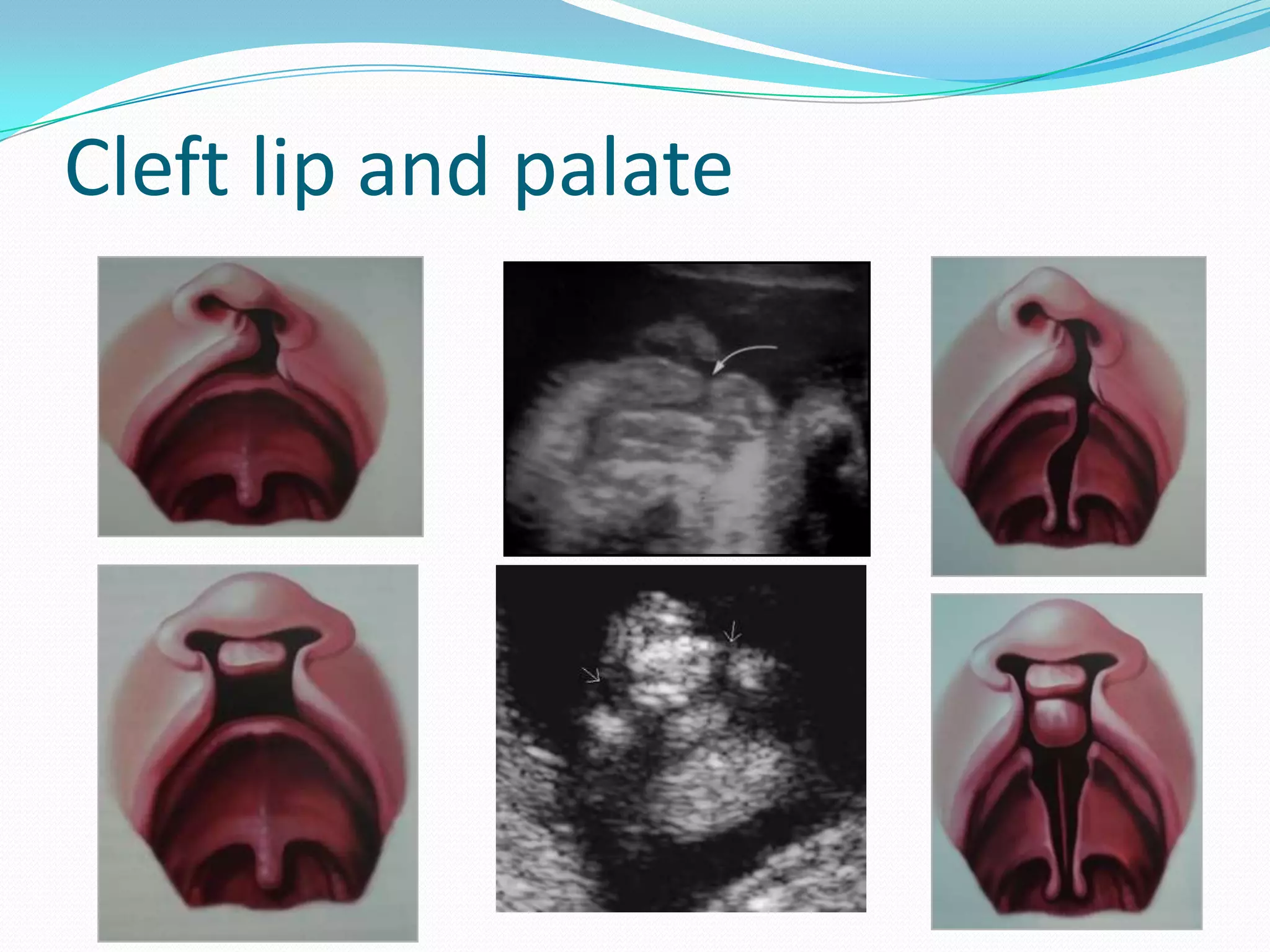 Cleft lip and palate
 
