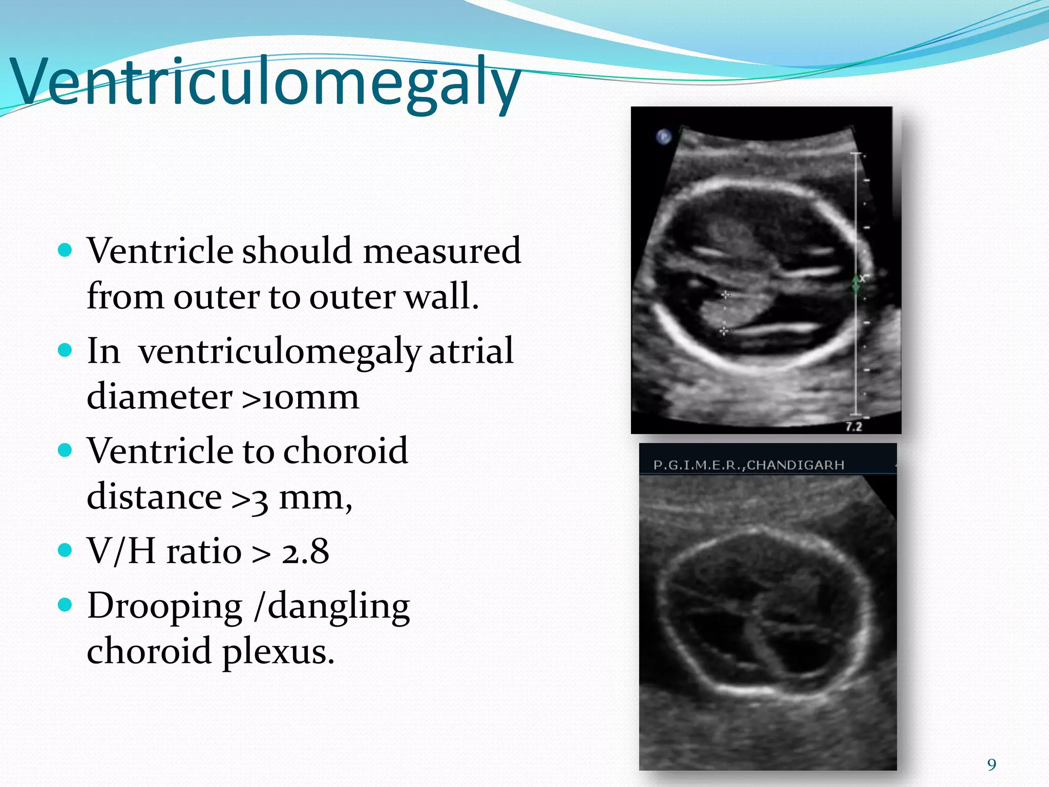 Ventriculomegaly

  Ventricle should measured
     from outer to outer wall.
    In ventriculomegaly atrial
     diameter >10mm
    Ventricle to choroid
     distance >3 mm,
    V/H ratio > 2.8
    Drooping /dangling
     choroid plexus.

                                  9
 
