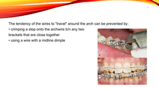 12
The tendency of the wires to "travel" around the arch can be prevented by:
• crimping a stop onto the archwire b/n any two
brackets that are close together
• using a wire with a midline dimple
 