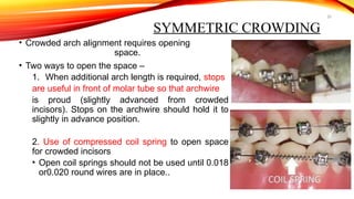 20
SYMMETRIC CROWDING
• Crowded arch alignment requires opening
space.
• Two ways to open the space –
1. When additional arch length is required, stops
are useful in front of molar tube so that archwire
is proud (slightly advanced from crowded
incisors). Stops on the archwire should hold it to
slightly in advance position.
2. Use of compressed coil spring to open space
for crowded incisors
• Open coil springs should not be used until 0.018
or0.020 round wires are in place..
 