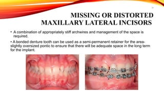24
MISSING OR DISTORTED
MAXILLARY LATERAL INCISORS
• A combination of appropriately stiff archwires and management of the space is
required.
• A bonded denture tooth can be used as a semi-permanent retainer for the area-
slightly oversized pontic to ensure that there will be adequate space in the long term
for the implant.
 