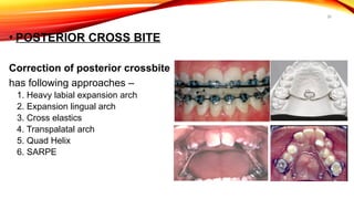 26
• POSTERIOR CROSS BITE
Correction of posterior crossbite
has following approaches –
1. Heavy labial expansion arch
2. Expansion lingual arch
3. Cross elastics
4. Transpalatal arch
5. Quad Helix
6. SARPE
 