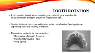 35
TOOTH ROTATION
• Tooth rotation, is defined as mesiolingual or distolingual interalveolar
displacement of the tooth around its longitudinal axis.
• Rotated teeth can be corrected by removable, semifixed or fixed appliance
depending upon the severity of rotation.
• The various methods for the correction:-
 Removable plate with Z- spring
 Modified Removable Plate
 Whip Spring
 