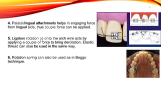 37
4. Palatal/lingual attachments helps in engaging force
from lingual side, thus couple force can be applied.
5. Ligature rotation tie onto the arch wire acts by
applying a couple of force to bring derotation. Elastic
thread can also be used in the same way.
6. Rotation spring can also be used as in Beggs
technique.
 