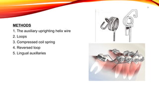 39
METHODS
1. The auxiliary uprighting helix wire
2. Loops
3. Compressed coil spring
4. Reversed loop
5. Lingual auxillaries
 
