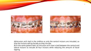 57
A)Intrusion arch tied in the midline as only the central incisors are intruded, so
that the incisors will tip facially as they intrude.
B) In the same patient later, an intrusion arch now is tied between the central and
lateral incisors to intrude all four incisors while reducing the amount of facial
tipping.
 