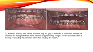 63
A) Auxiliary leveling wire before activation (B) by tying it beneath a continuous mandibular
archwire.The appropriate force in this instance is approximately 150 gm, and the expected action is
leveling by extruding the premolars rather than intruding the incisors
 
