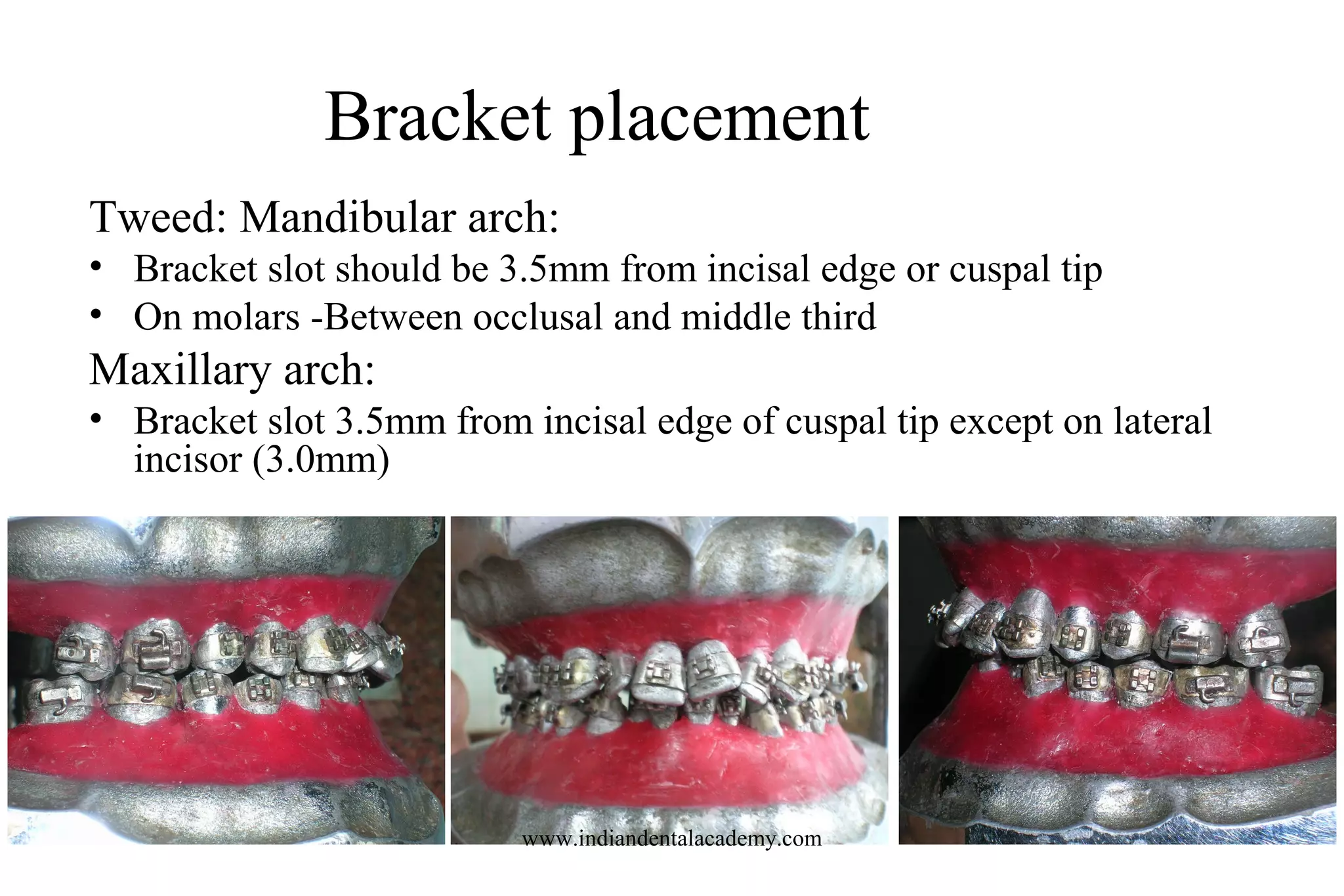 Bracket placement
Tweed: Mandibular arch:
• Bracket slot should be 3.5mm from incisal edge or cuspal tip
• On molars -Between occlusal and middle third
Maxillary arch:
• Bracket slot 3.5mm from incisal edge of cuspal tip except on lateral
incisor (3.0mm)
www.indiandentalacademy.com
 