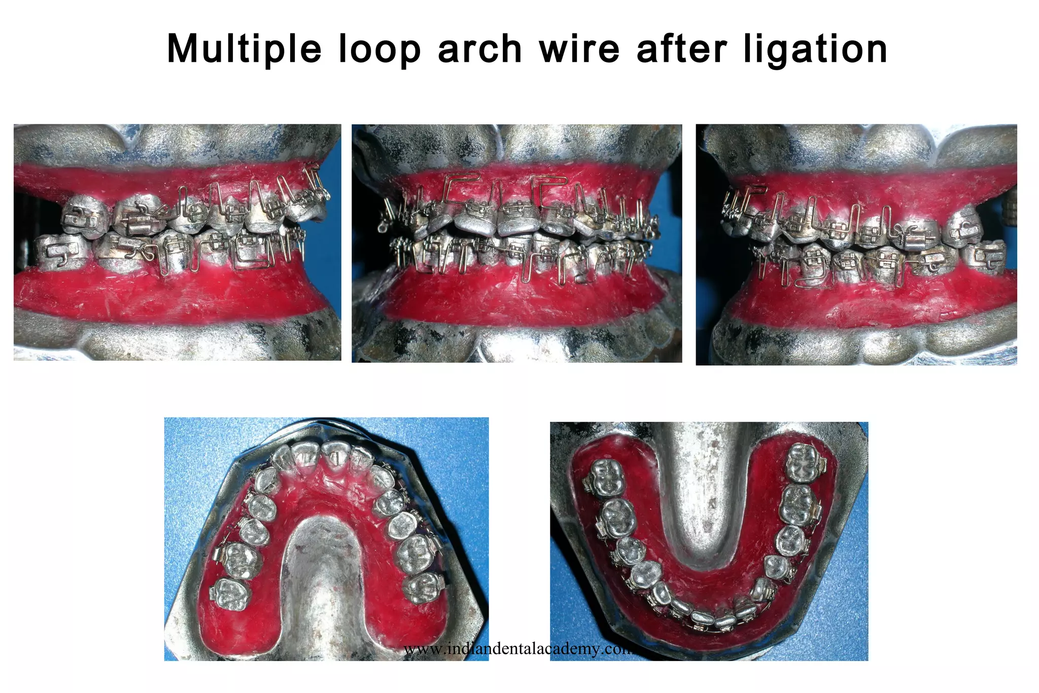 Multiple loop arch wire after ligation
www.indiandentalacademy.com
 