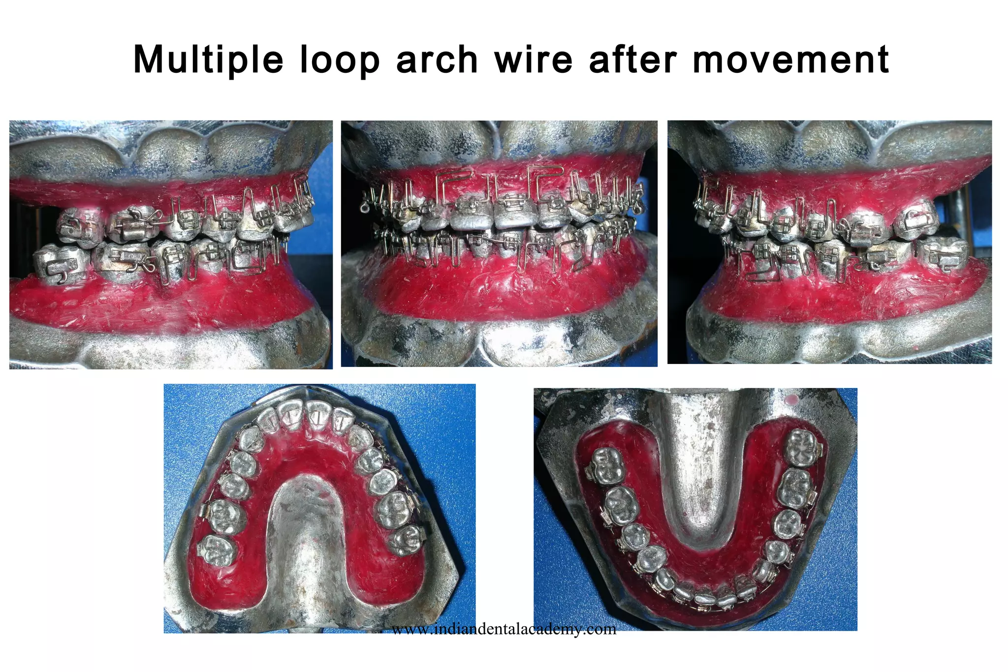Multiple loop arch wire after movement
www.indiandentalacademy.com
 