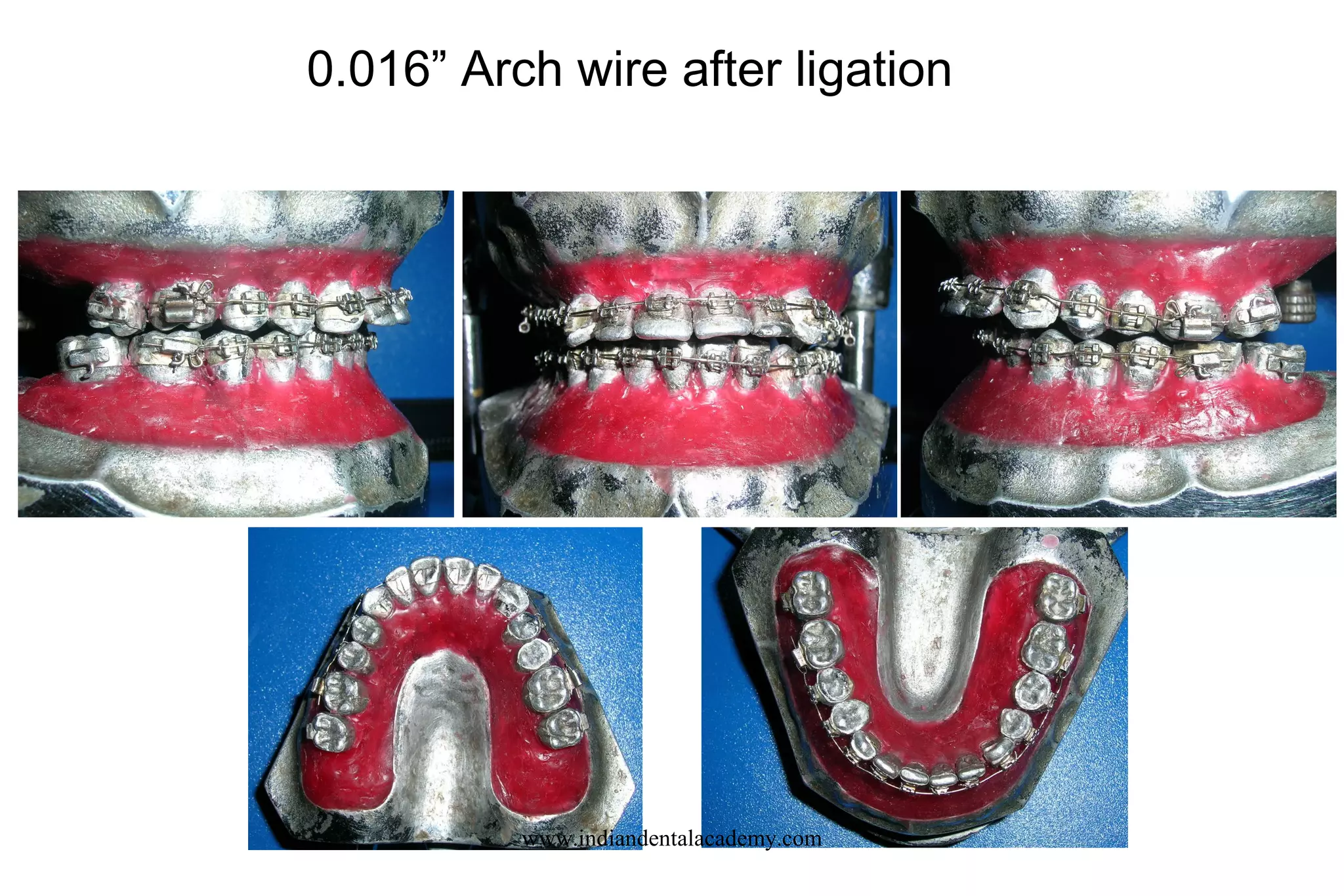 0.016” Arch wire after ligation
www.indiandentalacademy.com
 