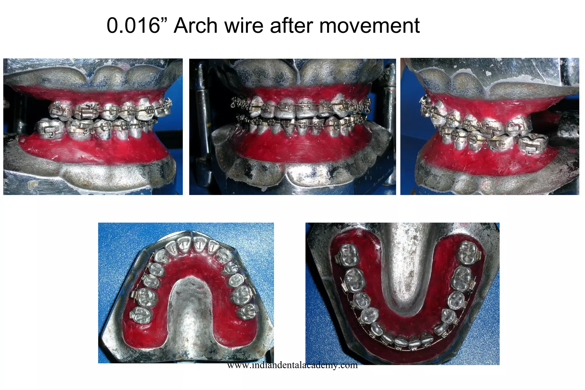0.016” Arch wire after movement
www.indiandentalacademy.com
 