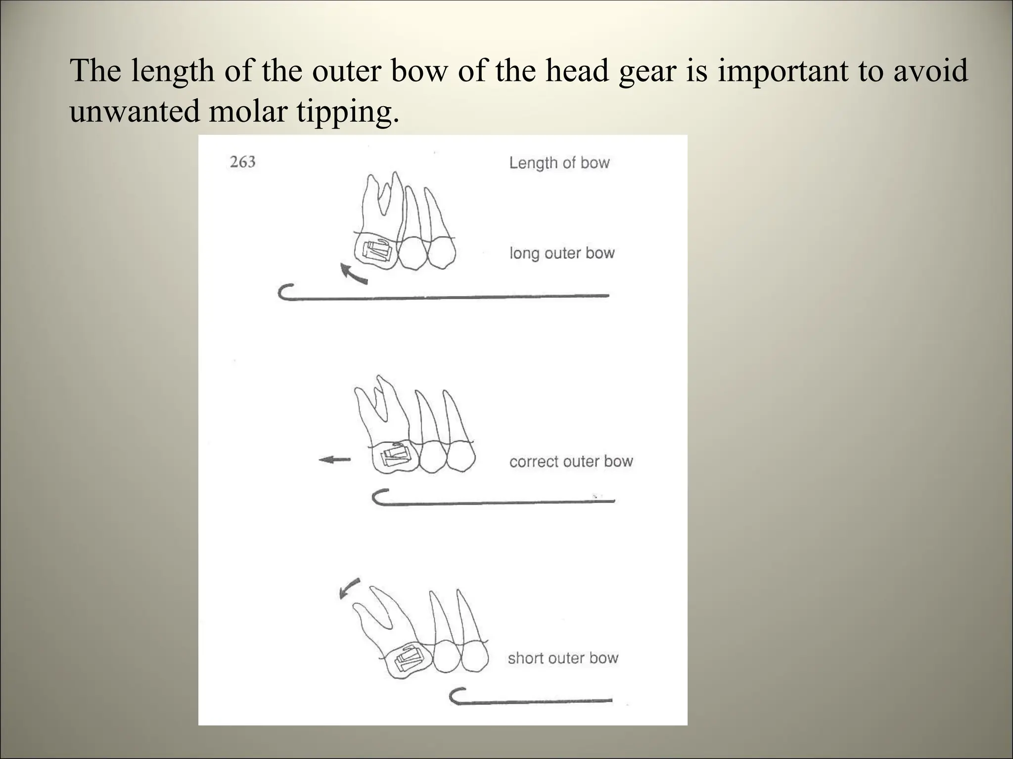 The length of the outer bow of the head gear is important to avoid
unwanted molar tipping.
 