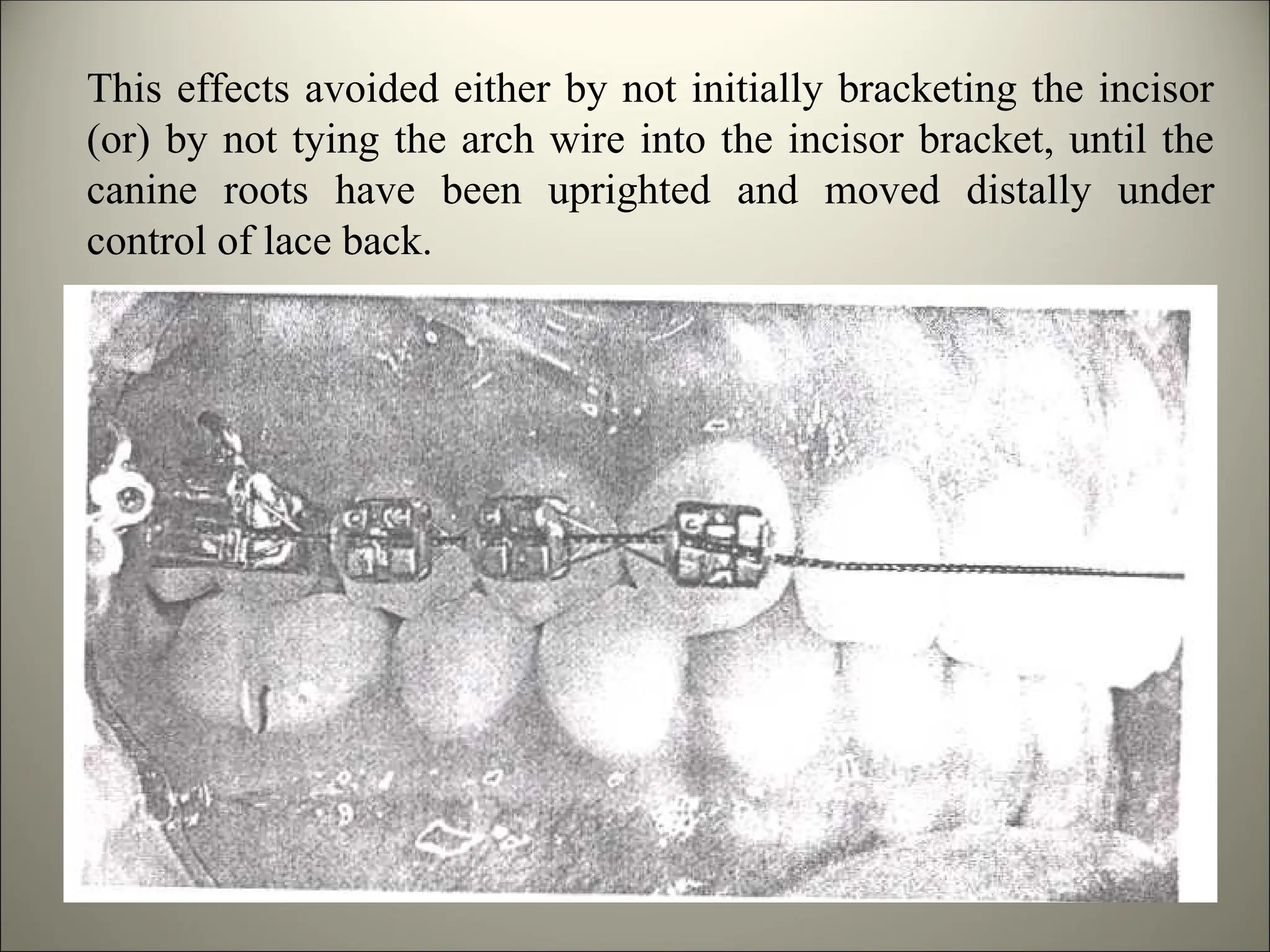 This effects avoided either by not initially bracketing the incisor
(or) by not tying the arch wire into the incisor bracket, until the
canine roots have been uprighted and moved distally under
control of lace back.
 
