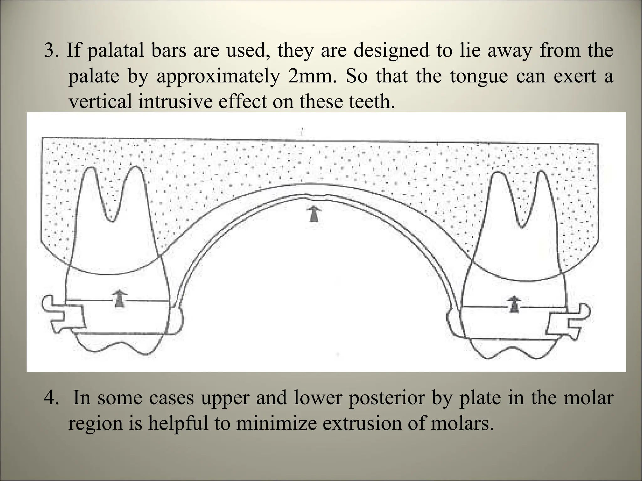 3. If palatal bars are used, they are designed to lie away from the
palate by approximately 2mm. So that the tongue can exert a
vertical intrusive effect on these teeth.
4. In some cases upper and lower posterior by plate in the molar
region is helpful to minimize extrusion of molars.
 