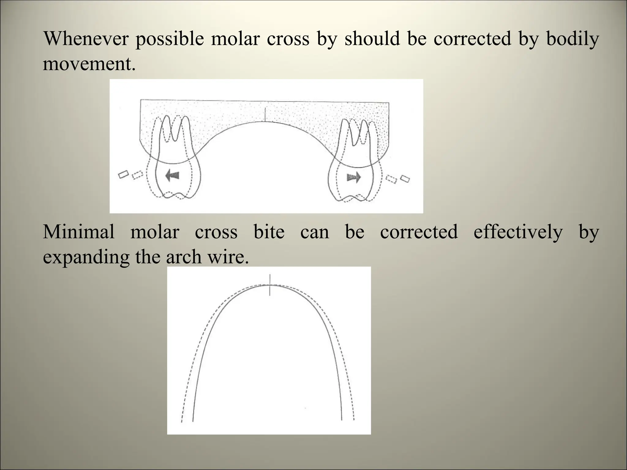 Whenever possible molar cross by should be corrected by bodily
movement.
Minimal molar cross bite can be corrected effectively by
expanding the arch wire.
 