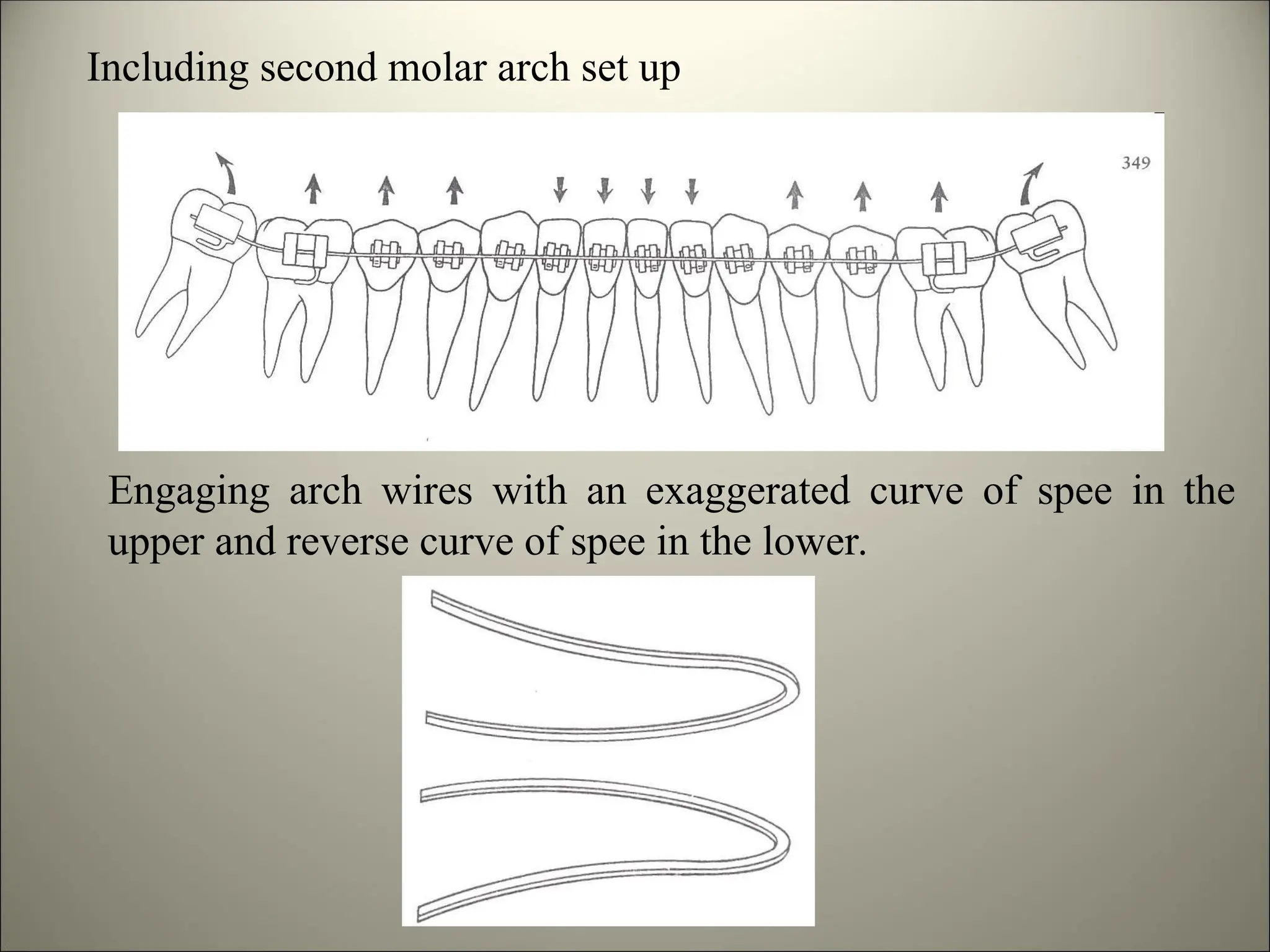 Including second molar arch set up
Engaging arch wires with an exaggerated curve of spee in the
upper and reverse curve of spee in the lower.
 