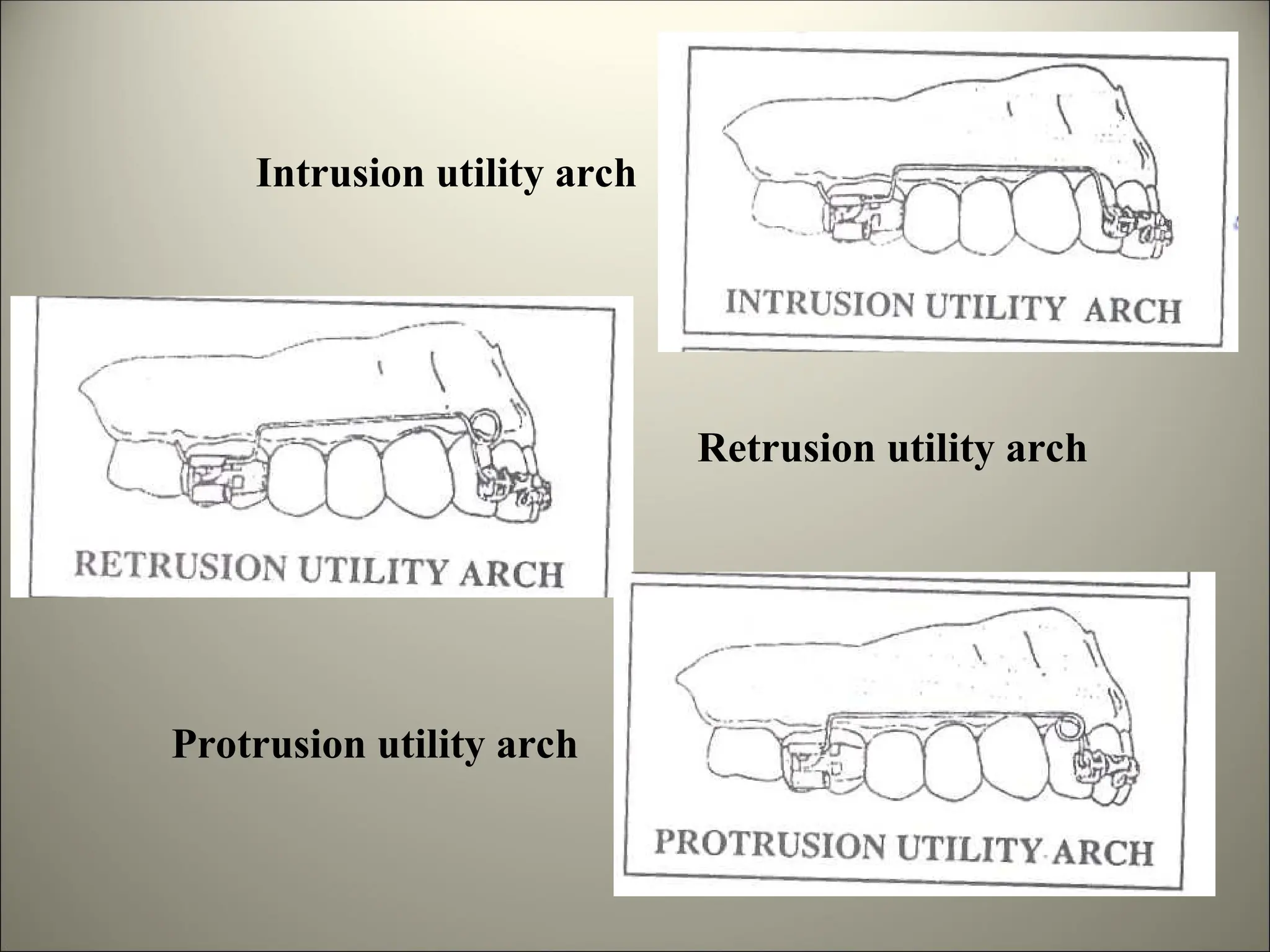 Intrusion utility arch
Retrusion utility arch
Protrusion utility arch
 