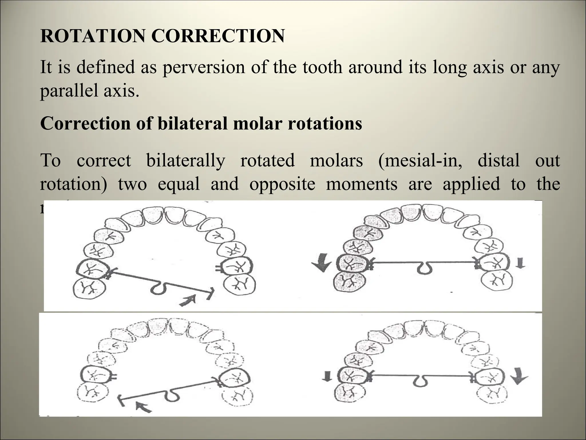 ROTATION CORRECTION
It is defined as perversion of the tooth around its long axis or any
parallel axis.
Correction of bilateral molar rotations
To correct bilaterally rotated molars (mesial-in, distal out
rotation) two equal and opposite moments are applied to the
molars.
 