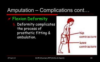 Amputation – Complications cont…
 Flexion Deformity
 Deformity complicates
the process of
prosthetic fitting &
ambulation.
27-Jul-13 Dr.PR Khuman,MPT(Ortho & Sport) 30
 
