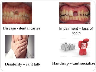Disease - dental caries Impairment – loss of
tooth
Disability – cant talk Handicap – cant socialize
 