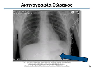 Ακτινογραφία θώρακος
“Fig: 3 (CR-1822)”, Capt Gary Chow, Katerina Achilleos and Col Hem Goshai, «
MEDICINE IN PICTURES: PURPLE URINE BAG SYNDROME»,
British Journal of Medical Practitioners, December 2011, Volume 4, No. 4 16
 