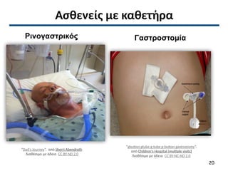 Ασθενείς με καθετήρα
“Dad's Journey”, από Sherri Abendroth
διαθέσιμο με άδεια CC BY-ND 2.0
“gbutton gtube g-tube g-button gastrostomy”,
από Children's Hospital (multiple visits)
διαθέσιμο με άδεια CC BY-NC-ND 2.0
20
Γαστροστομία
Ρινογαστρικός
 