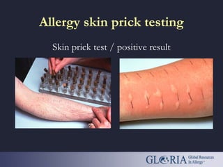Allergy skin prick testing
Skin prick test / positive result
 