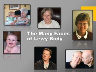 The Many Faces
of Lewy Body
 