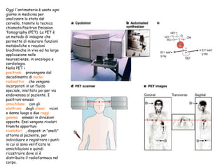 Oggi l'antimateria è usata ogni
giorno in medicina per
analizzare lo stato del
cervello, tramite la tecnica
chiamata Positron Emission
Tomography (PET). La PET è
un metodo di indagine che
permette di misurare funzioni
metaboliche e reazioni
biochimiche in vivo ed ha larga
applicazione nelle
neuroscienze, in oncologia e
cardiologia.
Nella PET i
positroni provengono dal
decadimento di nuclei
radioattivi che vengono
incorporati in un fluido
speciale, iniettato poi per via
endovenosa al paziente. I
positroni emessi
annichilano con gli
elettroni degli atomi vicini
e danno luogo a due raggi
gamma emessi in direzioni
opposte. Essi vengono rivelati
tramite opportuni
rivelatori , disposti in "anelli"
attorno al paziente, per
individuare e registrare i punti
in cui si sono verificate le
annichilazioni e quindi
ricostruire dove si è
distribuito il radiofarmaco nel
corpo.

 
