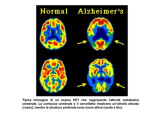 Tipica immagine di un esame PET che rappresenta l'attività metabolica
cerebrale. La corteccia cerebrale e il cervelletto mostrano un'attività elevata
(rosso), mentre le strutture profonde sono meno attive (verde e blu).

 