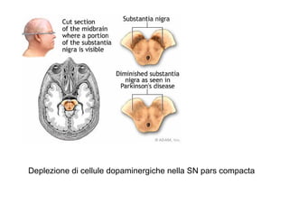 Deplezione di cellule dopaminergiche nella SN pars compacta
 
