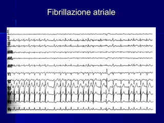 Fibrillazione atrialeFibrillazione atriale
 