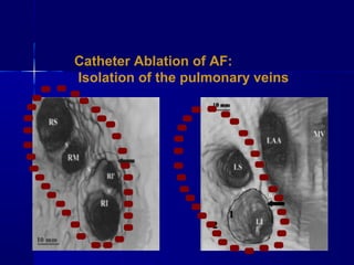 Catheter Ablation of AF:
Isolation of the pulmonary veins
 