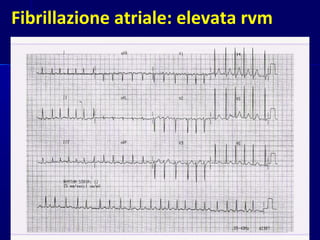 Fibrillazione atriale: elevata rvm
 