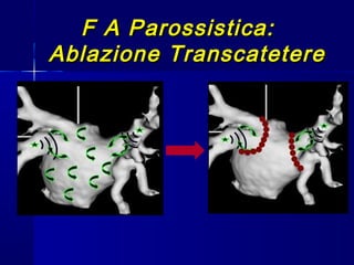 F A Parossistica:F A Parossistica:
Ablazione TranscatetereAblazione Transcatetere
 
