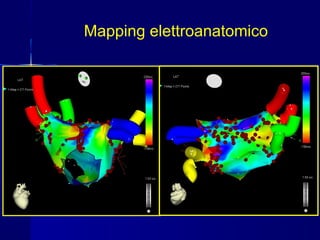 Mapping elettroanatomico
 