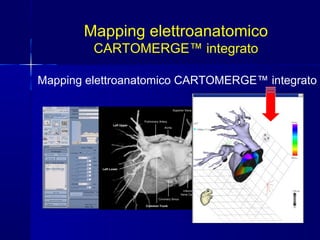 Mapping elettroanatomico CARTOMERGE™ integrato
Mapping elettroanatomico
CARTOMERGE™ integrato
 