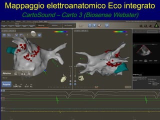 Mappaggio elettroanatomico Eco integrato
CartoSound – Carto 3 (Biosense Webster)
 