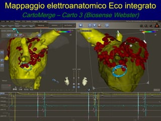 Mappaggio elettroanatomico Eco integrato
CartoMerge – Carto 3 (Biosense Webster)
 