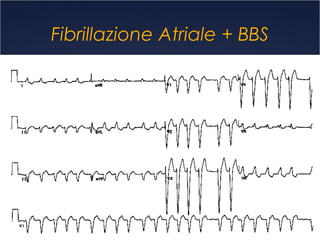 Fibrillazione Atriale + BBS
 