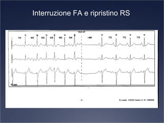 Interruzione FA e ripristino RS
 