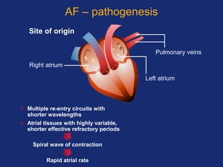 AF – pathogenesis
• Multiple re-entry circuits with
shorter wavelengths
• Atrial tissues with highly variable,
shorter effective refractory periods
Spiral wave of contraction
Rapid atrial rate
Pulmonary veins
Right atrium
Left atrium
Site of origin
 